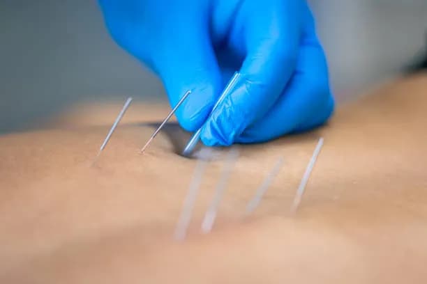 Dry Needling in Gurugram: Benefits, Uses & What to Expect