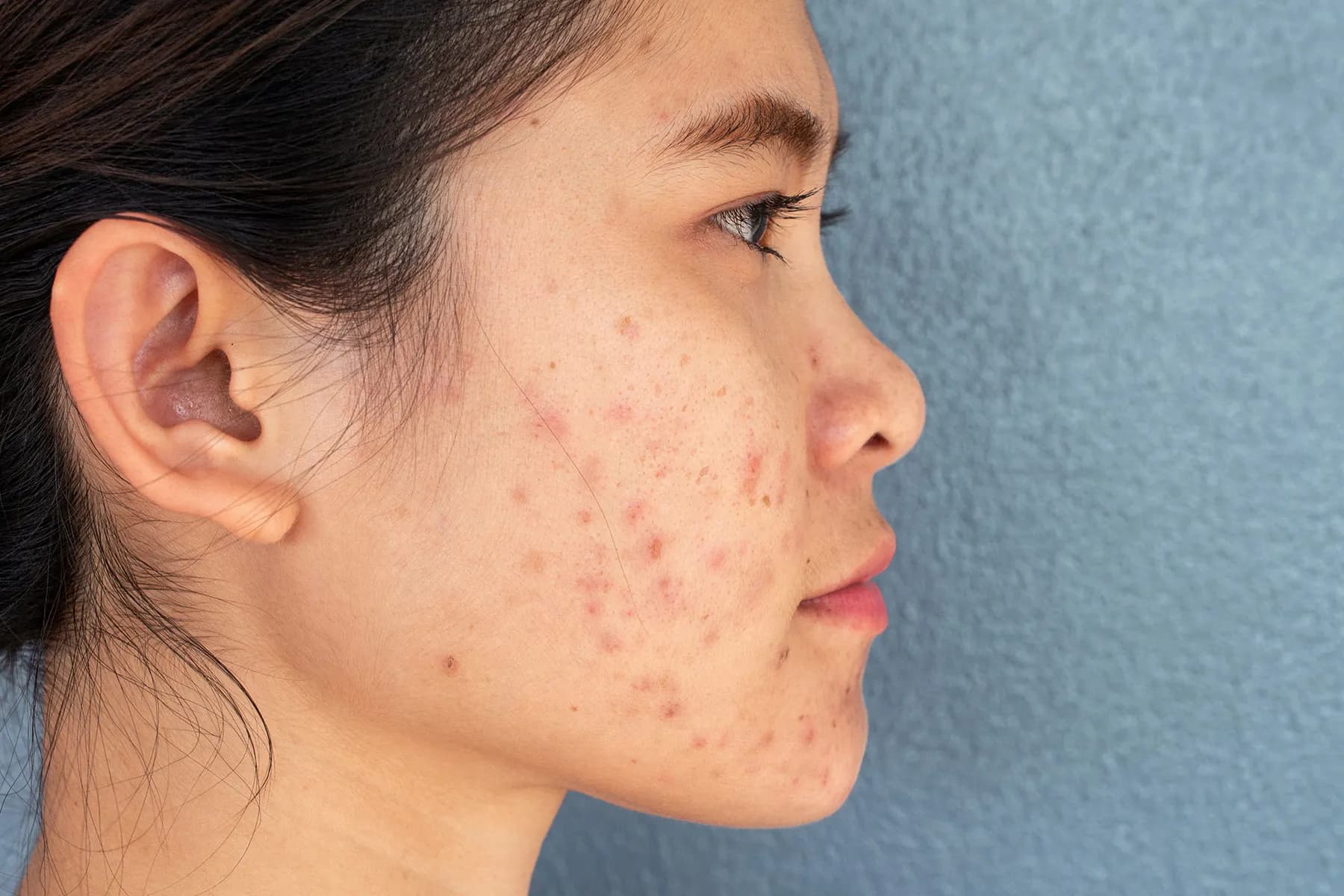 Acne Scar Treatment in Gurgaon | Profrea Skin Clinic